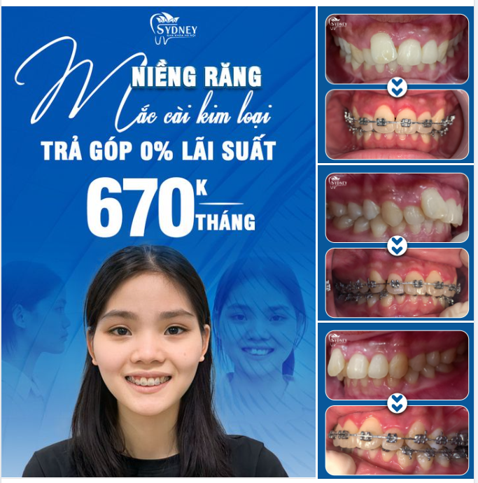 TỰ TIN ĐÓN NHẬN THÀNH CÔNG SAU KHI NIỀNG RĂNG TẠI NHA KHOA HÀ NỘI SYDNEY
