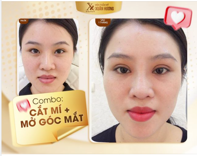 Combo cắt mí + mở góc mắt trong và đây là kết quả sau khi thực hiện của khách hàng tại Xuân Hương.