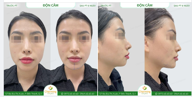 Nâng mũi khi chưa giải quyết vấn đề tỉ lệ khuôn mặt sẽ như thế nào?