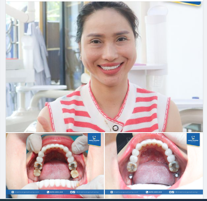 Hôm nay, chị Thanh Xuân đã được phục hình răng sứ trên implant.