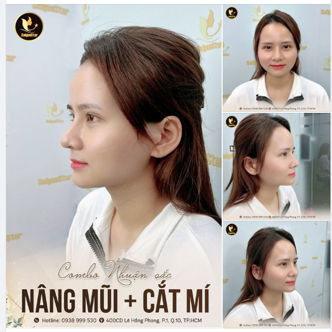 COMBO ĐẸP NHUẬN SẮC NÂNG MŨI + CẮT MÍ