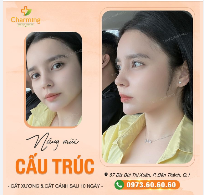 Chiếc mũi cấu trúc sụn sườn, cắt cánh mũi, cắt xương dù chỉ mới được 10 ngày thôi nhưng dáng mũi lên ưng quá nên phải lẹ lẹ chụp gửi feedback gửi Charming cho nóng.
