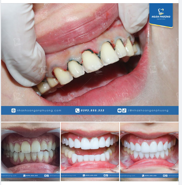 Veneer mài như không mài nhưng nói không mài xíu nào thì không đúng.