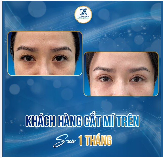 Chị khách hôm nay gặp tình trạng: nếp mí nhỏ , 2 bên nếp mí chưa đều nhau , da trùng nếp mí nhẹ, khách muốn thay đổi dáng mí phượng để nhìn đôi mắt tươi trẻ hơn.