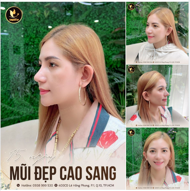 15 NGÀY MŨI ĐẸP CAO SANG