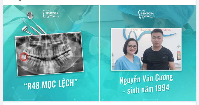 NHỔ RĂNG KHÔN NHANH CHÓNG, AN TOÀN BẰNG MÁY SIÊU ÂM