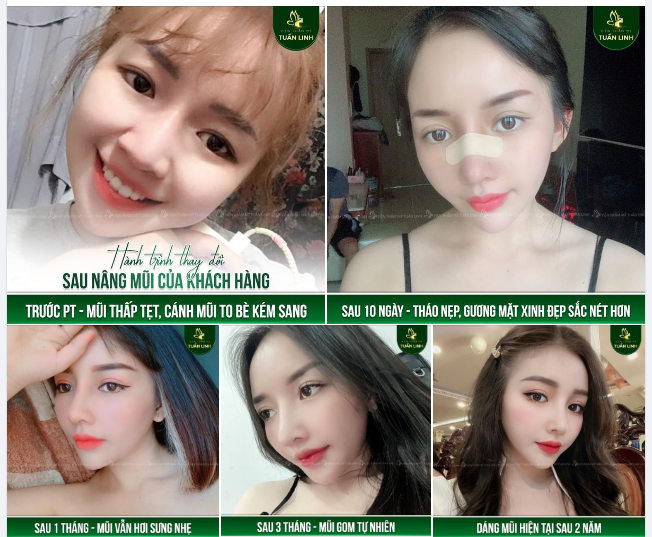 Hành trình THAY ĐỔI SAU NÂNG MŨI của khách hàng xinh đẹp nhưng không may sở hữu chiếc mũi tẹt kém sang.