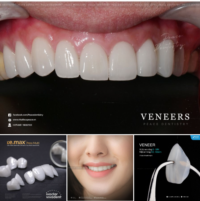 MẶT SỨ VENEER - CHIẾC MẶT NẠ TỰ NHIÊN HOÀN HẢO CHO NỤ CƯỜI RẠNG RỠ