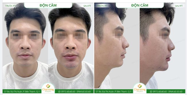 Bức ảnh này sẽ cho bạn thấy rõ ràng hiệu quả của phẫu thuật độn cằm, đặc biệt là ở nam giới.