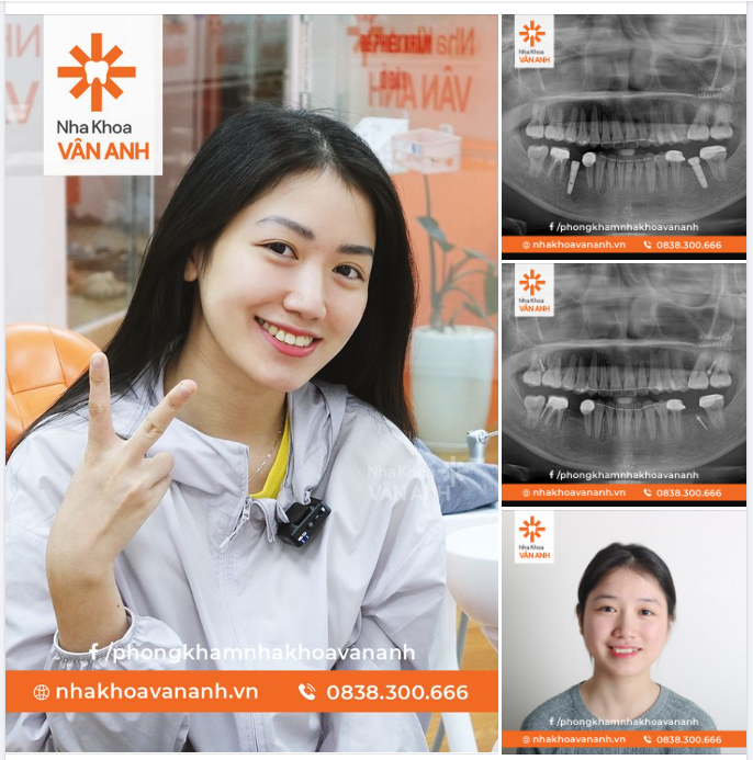 CHỌN NIỀNG RĂNG ĐỂ CƯỜI TỰ TIN - CHỌN IMPLANT ĐỂ ĂN NHAI CHẮC KHỎE, BỀN LÂU