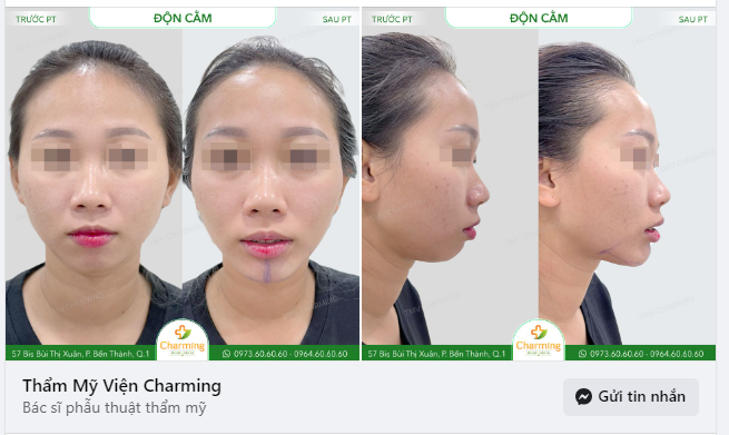 Bạn đã bao giờ thấy một khuôn mặt mà phía trước trông bình thường như khi nhìn ngang thì lại "quá khổ" không?