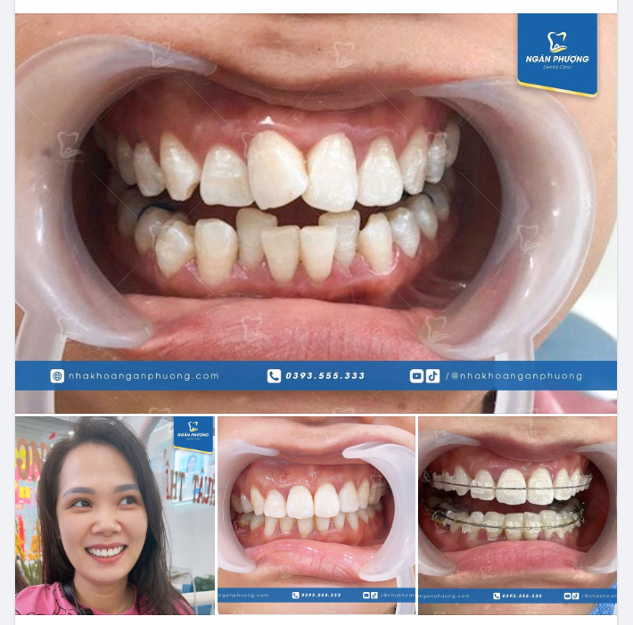 Hỡi cô răng có gắn niềng,  Hỏi xem liệu có ưu phiền hay chăng?