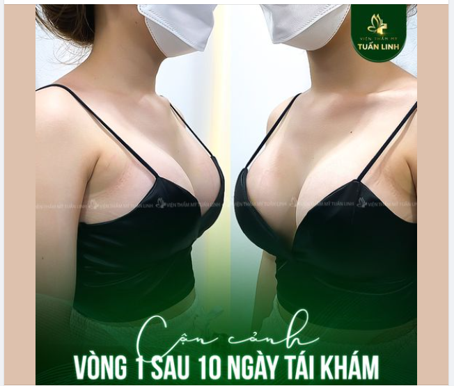 CẬN CẢNH VÒNG 1 SAU 10 NGÀY TÁI KHÁM