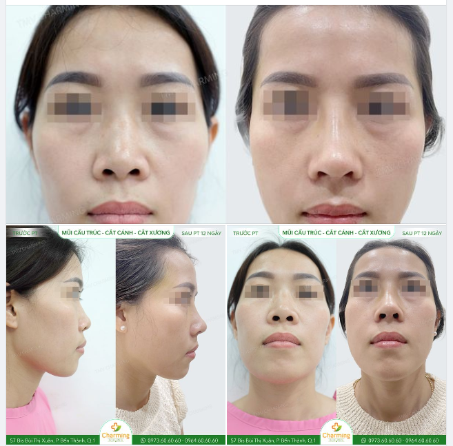 Khi đã chọn phẫu thuật nâng mũi, tất nhiên mọi người sẽ chọn phương án giúp mình có được vẻ đẹp rạng ngời.