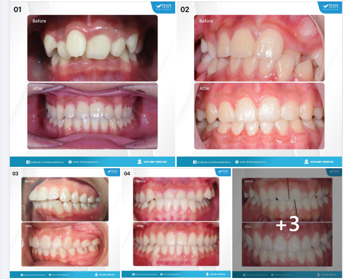 Hãy để Peace Dentistry có cơ hội được đồng hành trên chặng đường kiến tạo lại nụ cười và góp phần để bạn tỏa sáng theo cách mà bạn muốn.