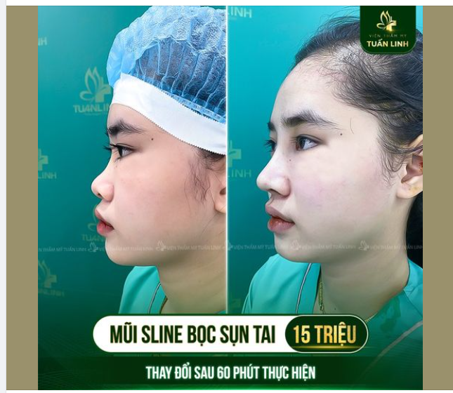 Gì cơ: Nâng mũi mà có 15 triệu, thật hả ?