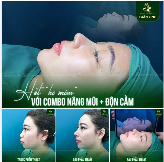 NÂNG MŨI + ĐỘN CẰM