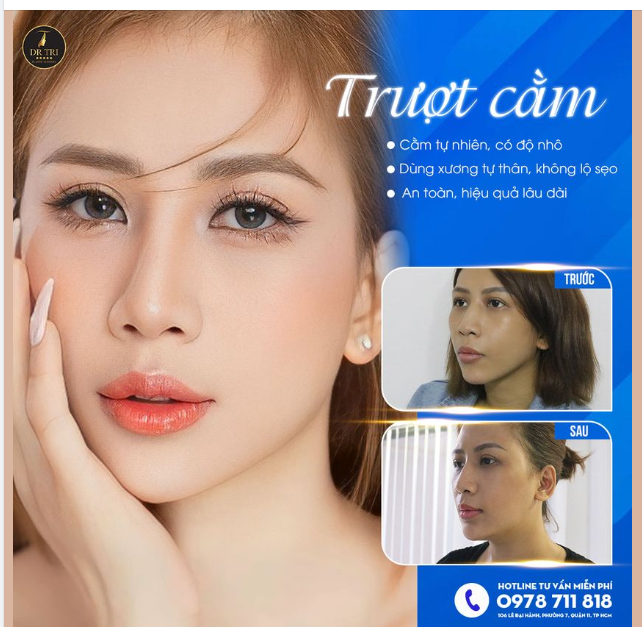 TRƯỢT CẰM V-LINE VĨNH VIỄN CÓ THẬT KHÔNG?
