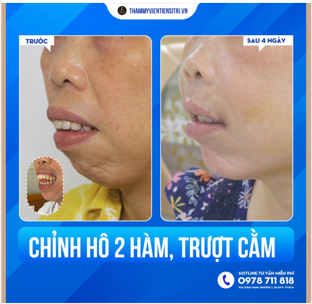 KẾT QUẢ SAU 4 NGÀY CHỈNH HÔ HÀM TRÊN - THIỂU SẢN XƯƠNG HÀM DƯỚI