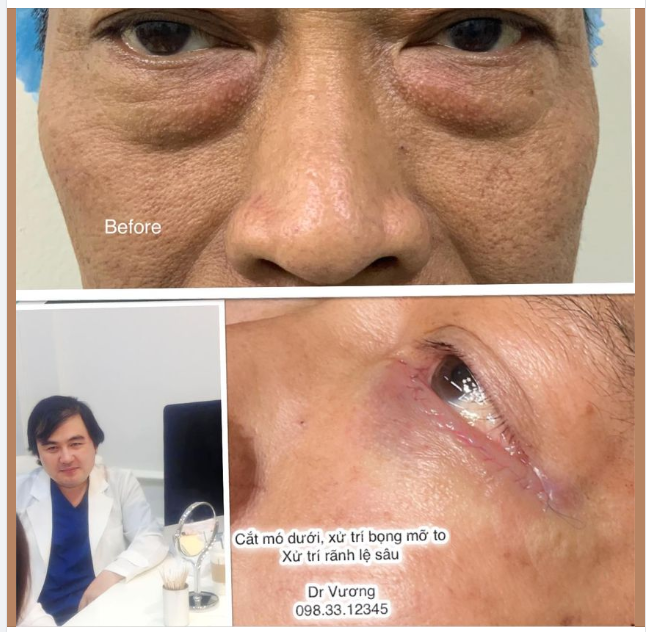 Trẻ hoá vùng mí dưới với Dr Vương … cho bác zai ở Q3