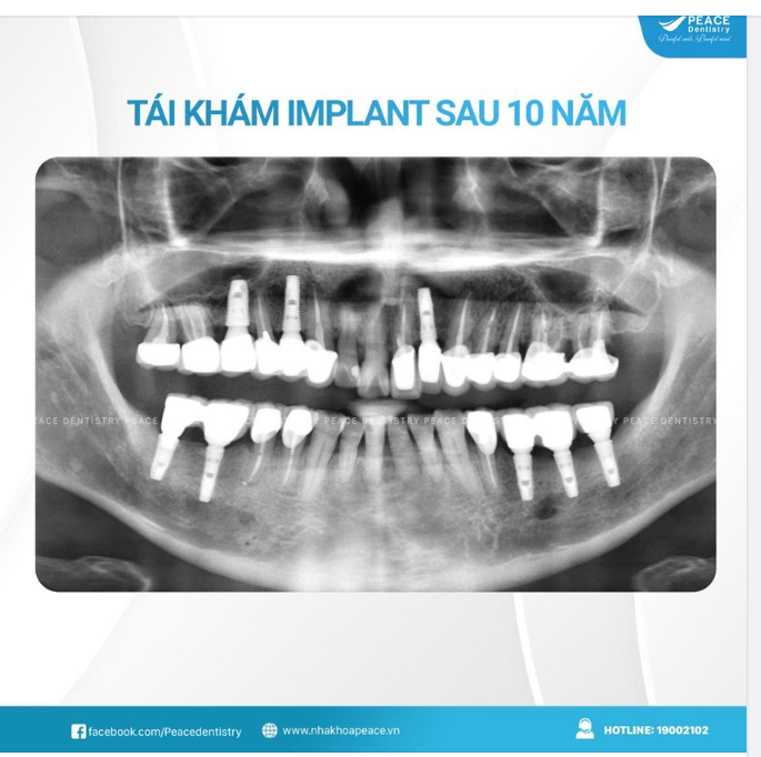 RĂNG IMPLANT - 10 NĂM NHÌN LẠI, CẢM XÚC GÓI GỌN TRONG 2 CHỮ "TUYỆT VỜI"