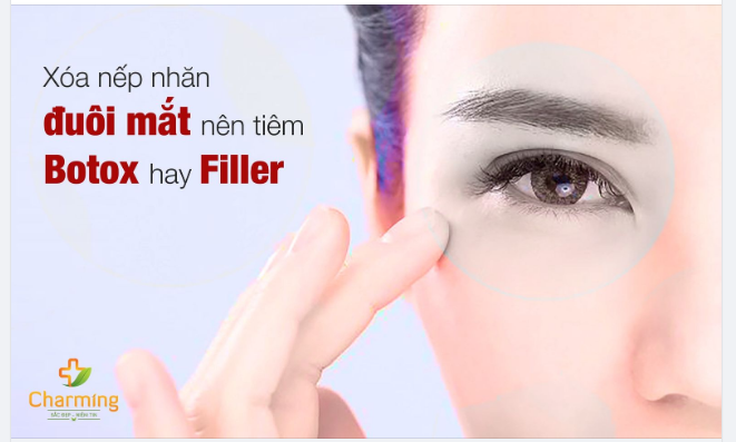 XỬ LÝ NẾP NHĂN ĐUÔI MẮT BẰNG BOTOX HAY FILLER?