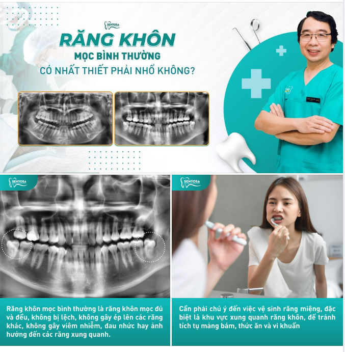 RĂNG KHÔN MỌC BÌNH THƯỜNG CÓ NHẤT THIẾT PHẢI NHỔ KHÔNG?