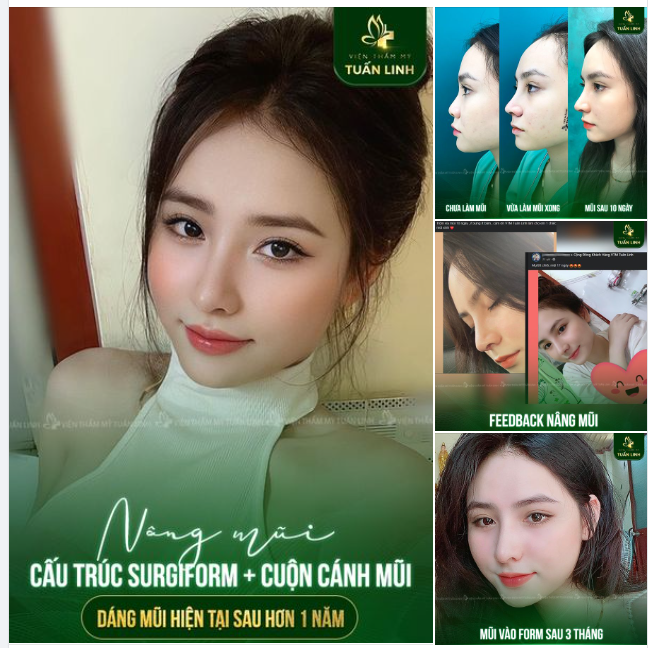 Nâng mũi cấu trúc sử dụng sụn Surgiform kết hợp cuộn cánh mũi  Phương pháp sửa mũi toàn diện cho dáng mũi đẹp hoàn hảo và bền chắc cùng thời gian.