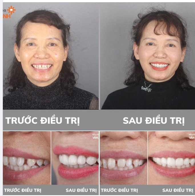 ĐÓNG CHẶT KHE THƯA - RĂNG ĐẸP RẠNG NGỜI NHỜ DÁN SỨ VENEER