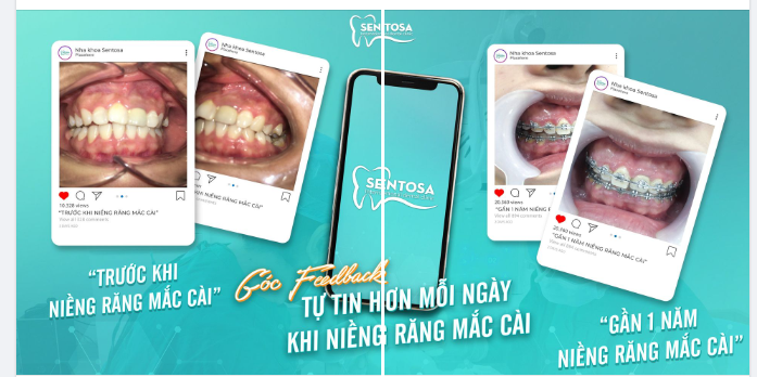 TỰ TIN HƠN MỖI NGÀY KHI NIỀNG RĂNG MẮC CÀI