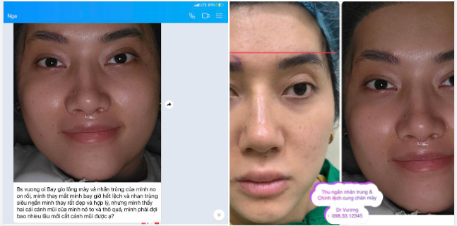 Feedback về thu ngắn nhân trung  chỉnh cung mày lệch (bên cao - bên thấp) với Dr Vương