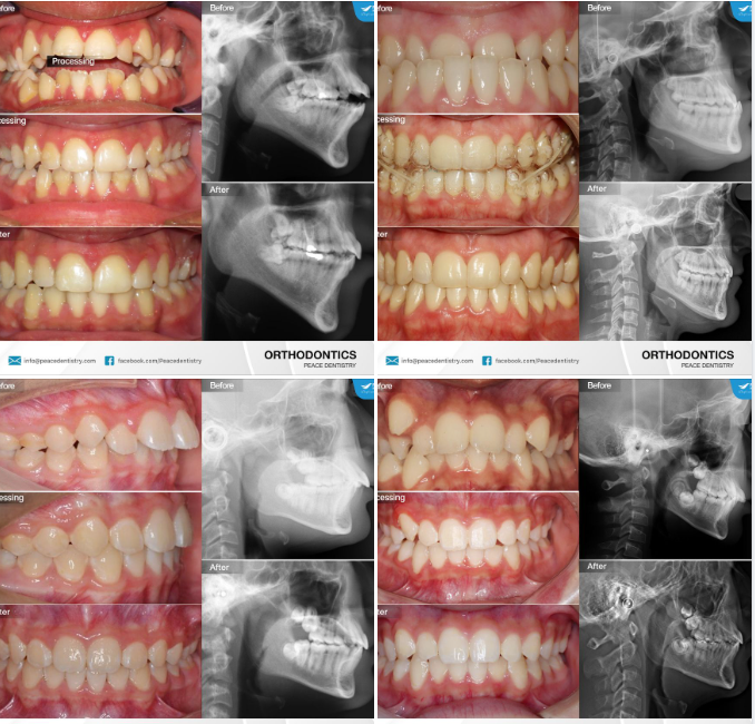 Một số ca lâm sàng niềng răng Invisalign với đa dạng các trường hợp: hô, móm, răng chen chúc xô lệch, cắn hở, cắn sâu...