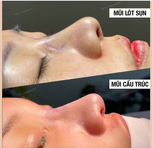 KHÁC BIỆT TRONG TỈ LỆ SỤN NHÂN TẠO CỦA NÂNG MŨI CẤU TRÚC VÀ NÂNG MŨI LÓT SỤN