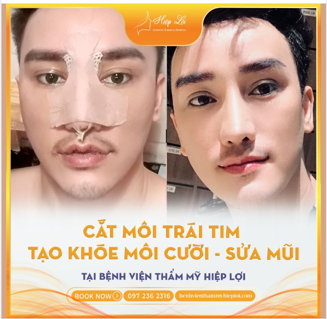 CHÀNG TRAI LỘT XÁC SAU PHẪU THUẬT THẨM MỸ