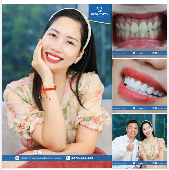 Hành trình 14 ngày cắt lợi, làm sứ, thay đổi toàn diện của chị Trà My