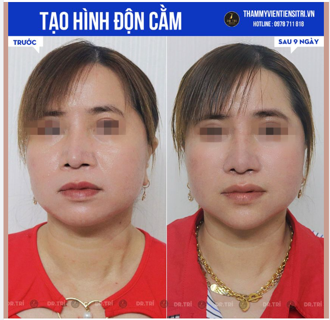 THAY ĐỔI NHẸ CHO GƯƠNG MẶT VỚI TẠO HÌNH CẰM