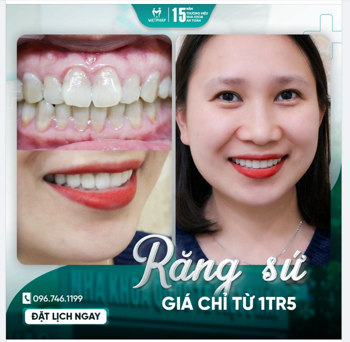 RĂNG SỨ THẨM MỸ TẠI VIỆT PHÁP - TỰ TIN VỚI NỤ CƯỜI HOÀN HẢO