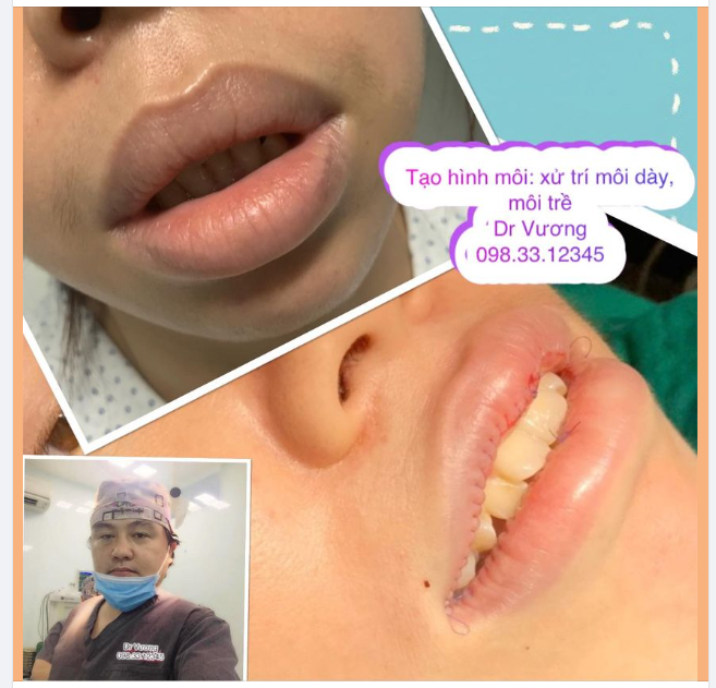 Tạo hình môi với Dr Vương