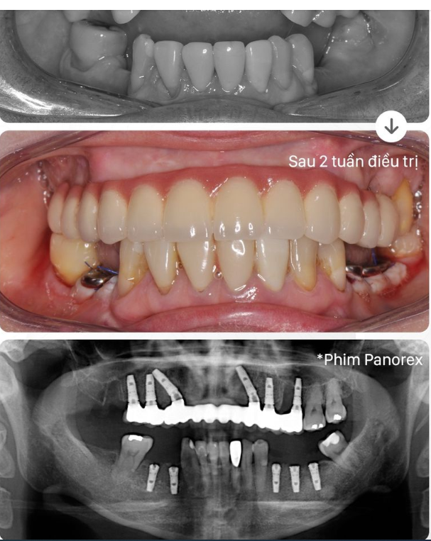 TRỒNG RĂNG IMPLANT TOÀN HÀM ALL-ON-X LÀ SỰ THAY THẾ HOÀN HẢO CHO HÀM THÁO LẮP.