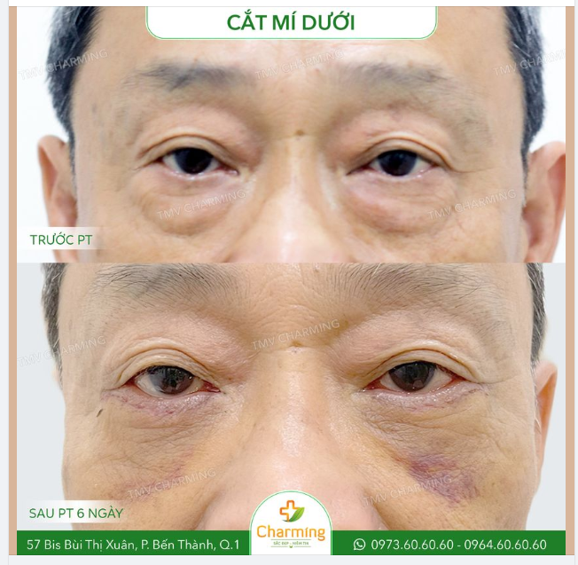 Không chỉ phụ nữ mà thậm chí cánh mày râu cũng có thể cắt mí dưới đó nha.