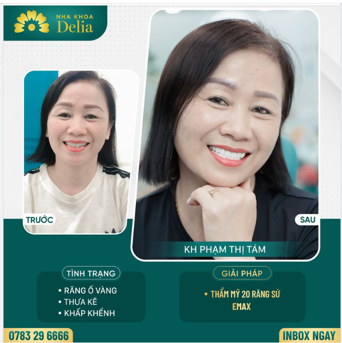 Thẩm mỹ răng sứ - Kiến tạo nụ cười khoẻ đẹp tự nhiên