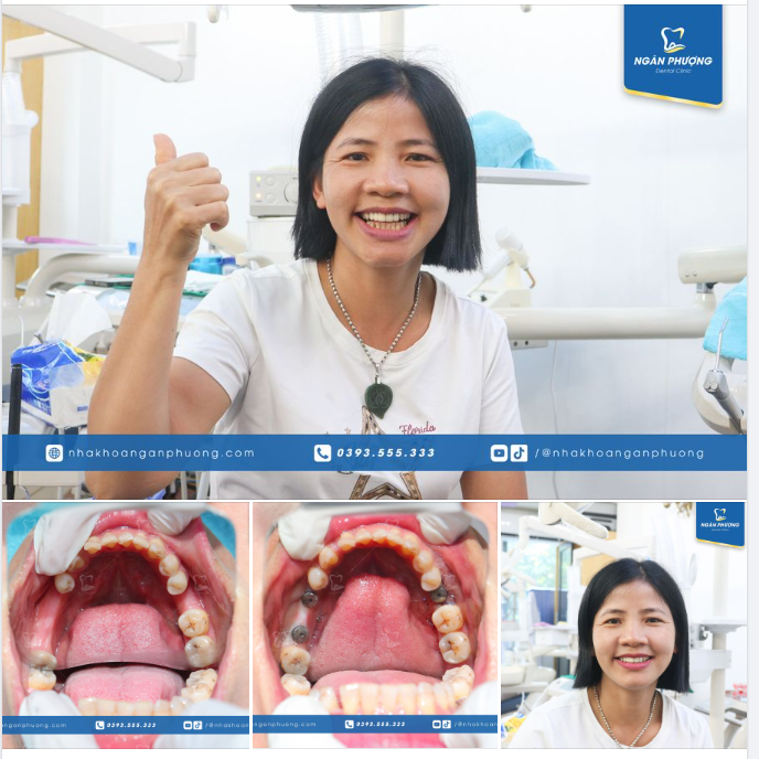 Cắm 3 trụ bằng 2 phương pháp khác nhau nhưng chị Minh vẫn nở một nụ cười thật tươi vì “trồng implant ở Ngân Phượng không đau, không chảy m.áu”
