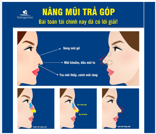 NÂNG MŨI TRẢ GÓP - AI NÂNG CŨNG ĐẸP