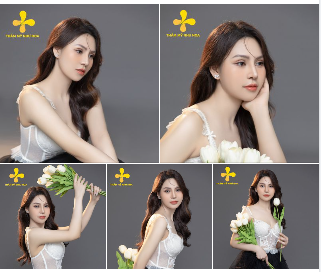 Bộ ảnh đánh dấu 1 tháng sở hữu dáng mũi mới của bạn khách hàng Thẩm mỹ Như Hoa.