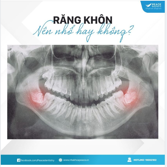 RĂNG KHÔN: NÊN NHỔ HAY KHÔNG?