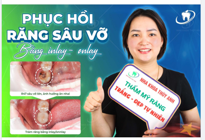 NHA KHOA THUỲ ANH - TIÊU CHÍ BẢO TỒN RĂNG THẬT LÀ ƯU TIÊN SỐ 1