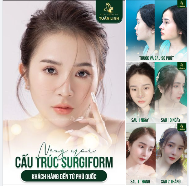 Nâng mũi cấu trúc Surgiform - Dáng mũi sau hơn 1 năm của bạn khách hàng đến từ Phú Quốc!!