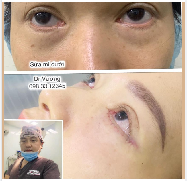 Dr Vương sửa mí dưới cho bạn gái SG: