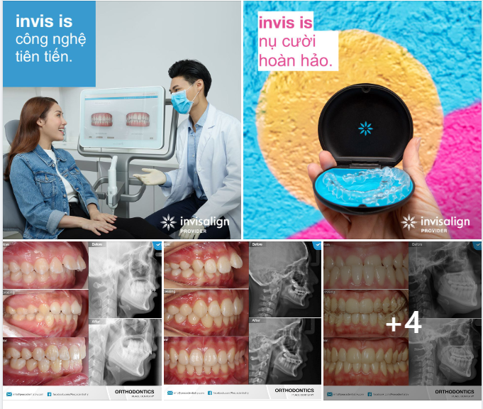 XOÁ BỎ 05 RÀO CẢN KHIẾN BẠN NGẦN NGẠI QUYẾT ĐỊNH NIỀNG RĂNG INVISALIGN