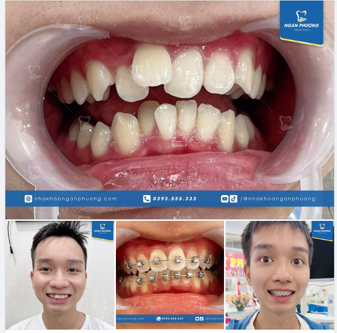Biết điểm đại học rồi, Niềng răng thôi